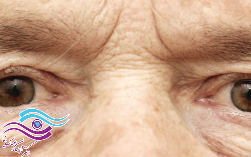 بیماری پیر چشمی