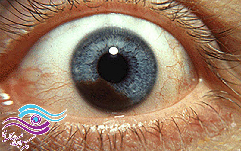 تومور ملانوم چشم چیست