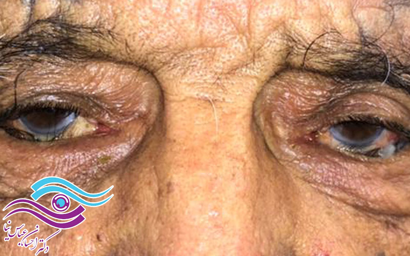 بیماری آنتروپیون چشم چیست