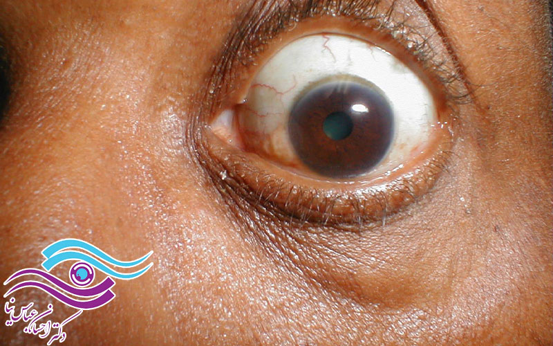 درمان تنگی مردمک چشم