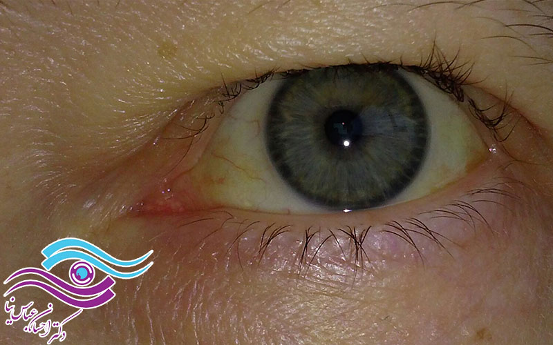 مهم ترین علت زردی چشم