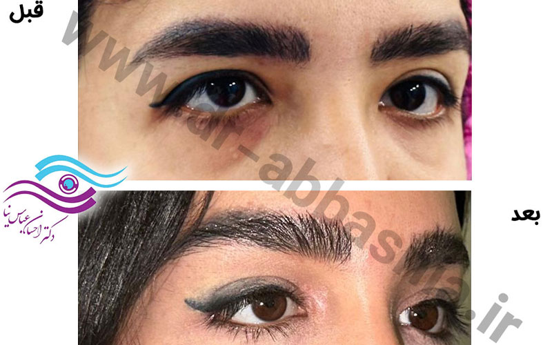 هزینه لیفت پیشانی و ابرو