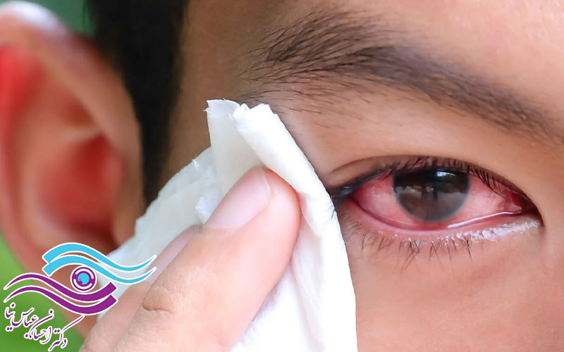 مراقبت از چشم‌ها در برابر موج انفجار