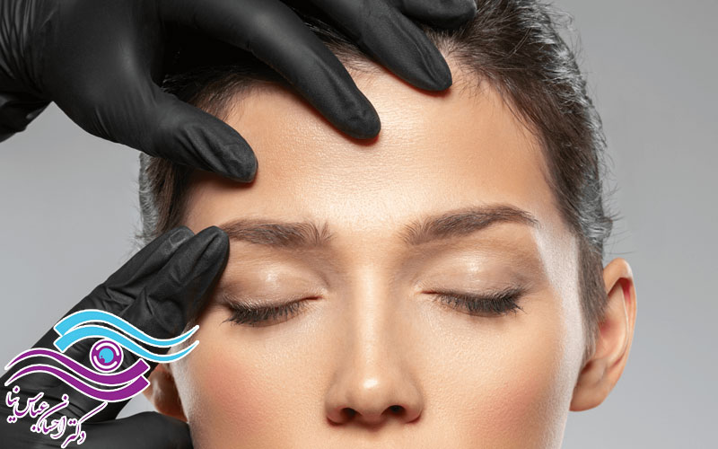 لیفت شقیقه برای رفع افتادگی گوشه چشم