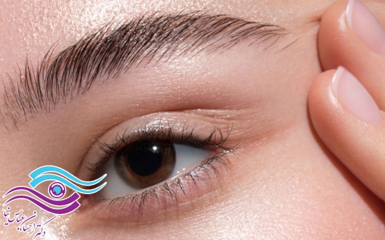 لیفت شقیقه برای رفع افتادگی گوشه چشم