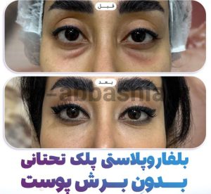 عکس قبل و بعد بلفاروپلاستی پلک تحتانی
