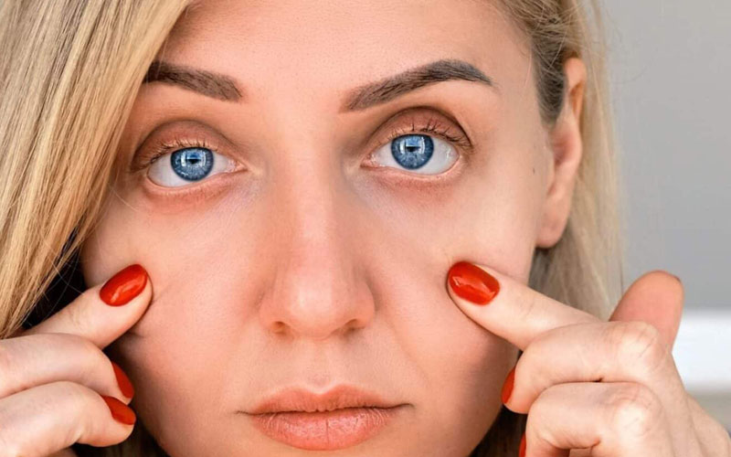 کاهش پف و تیرگی دائمی زیر چشم