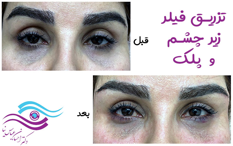 تزریق فیلر زیر چشم و پلک