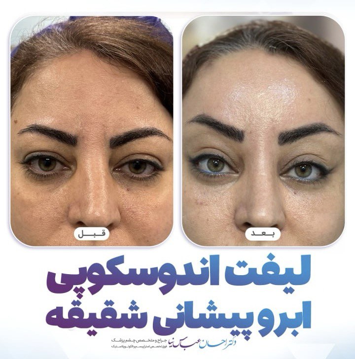 لیفت اندوسکوپی ابرو پیشانی شقیقه